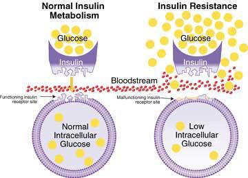 Insulin resistance, are you insulin resistant? women