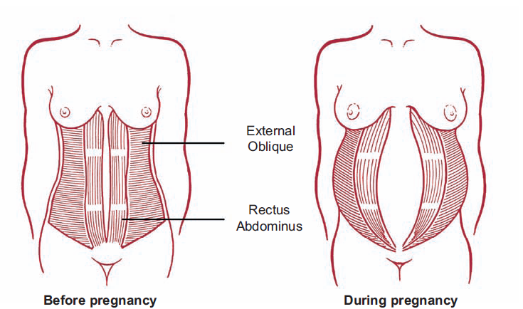 diastasis recti pregnancy