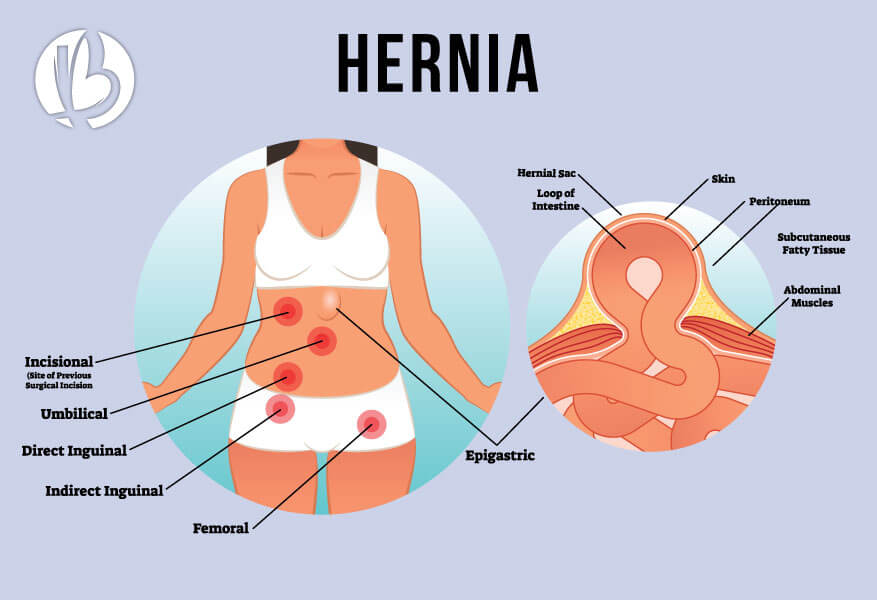 What is a postpartum umbilical hernia?